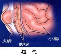 最易复发的时间在术后6~12个月以内,腹股沟直疝术后复发是斜疝的4倍